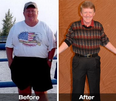 Dave M. before and after Roux-en-Y gastric bypass surgery.