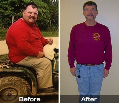 Glynn G. before and after Roux-en-Y gastric bypass surgery.