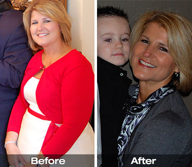 JereS-before-after Jere S. before and after weight loss surgery.