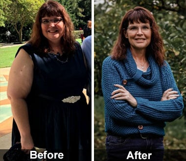 Kari H. before and after sleeve gastrectomy procedure.