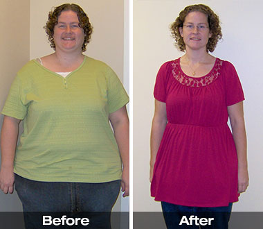 Karla B. before and after weight loss surgery.