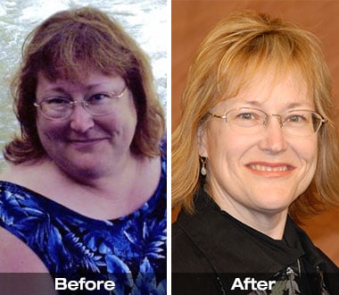 Kay F. before and after weight loss surgery.