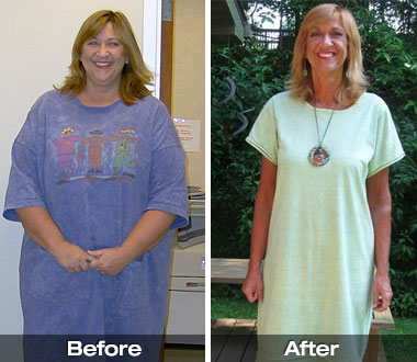 Linda T. before and after medically supervised weight loss and Roux-en-Y gastric bypass surgery.