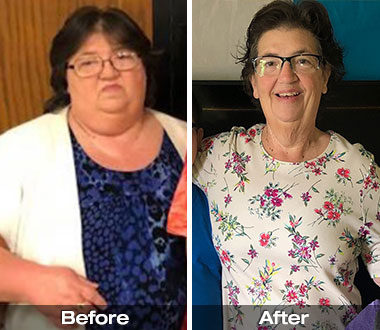 Nettie R. before and after Roux-en-Y gastric bypass procedure.