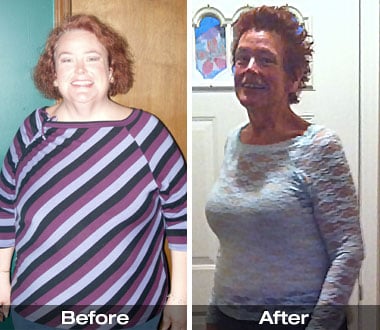 Rhonda M. before and after Roux-en-Y gastric bypass surgery.