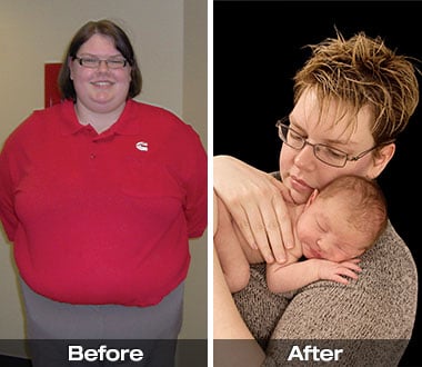 Sara G. before and after gastric sleeve bypass surgery.