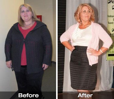 Stacie V. before and after Roux-en-Y gastric bypass surgery.
