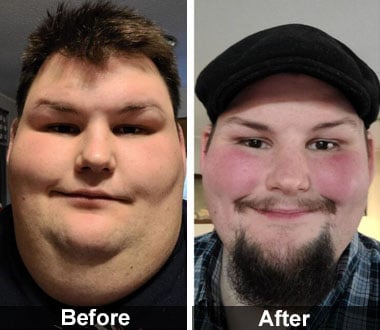 Tyler F. before and after medically-supervised weight loss and sleeve gastrectomy.
